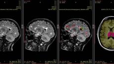 Automatic MRI scan analysis report generated by SNAC's AI-based platform iQ-solutions