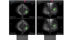 An analysis report generated by the Lunit INSIGHT DBT