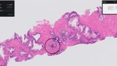 Paige Prostate software identifying a suspicious area in a biopsy slide