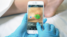 A smartphone analyzing a wound using Swift's app