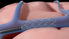 Animated image of Synchron's Stentrode device getting implanted into the brain