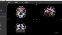 Neurophet's brain MRI scan analysis AI software shown on a desktop monitor