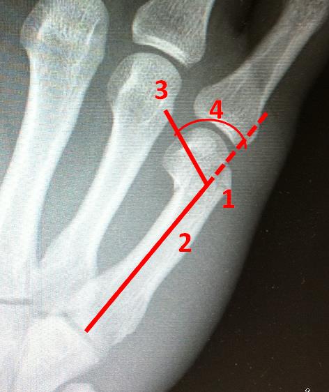 hand fracture JMIR